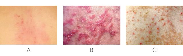 Keto Rash: What is it, and How Can it Be Resolved?